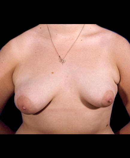 Asymmetrical Breast Front View Before