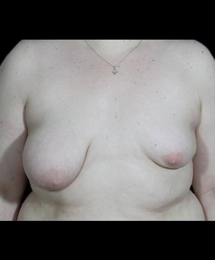 Asymmetrical Breast Surgery Front View Before