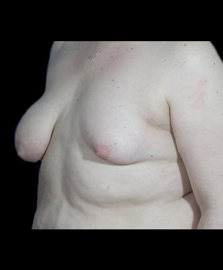 Asymmetrical Breast Surgery Quarter View Before