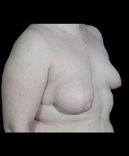 Asymmetrical Breast Surgery Before