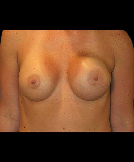 Asymmetrical Breast Correction Front View Before