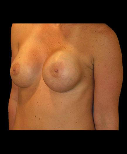 Asymmetrical Breast Correction Quarter View Before