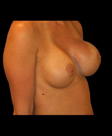 Asymmetrical Breast Correction Before