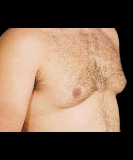 Gynecomastia Before