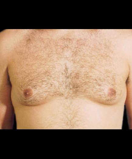 Gynecomastia Surgery Before