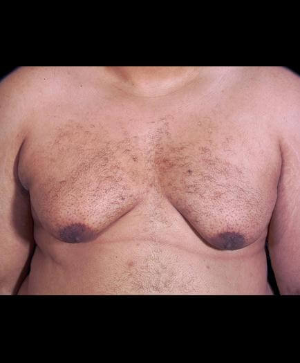 Male Breast Reduction Surgery Before