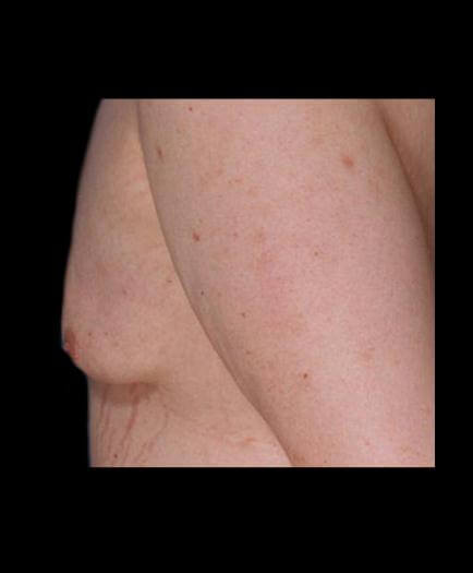 Before Gynecomastia Surgery