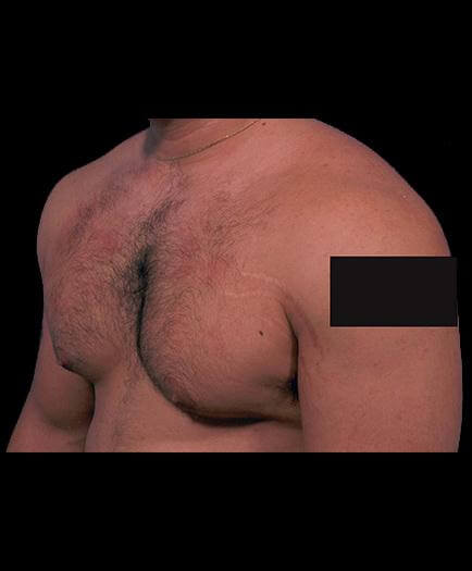 Before Male Breast Reduction Surgery