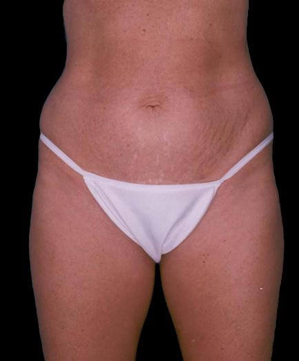 Tummy Tuck Surgery Before