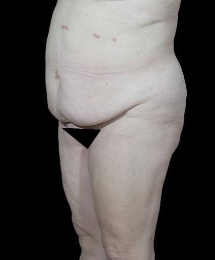 Abdominoplasty Before