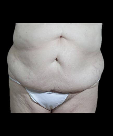 Abdominoplasty Surgery Before	