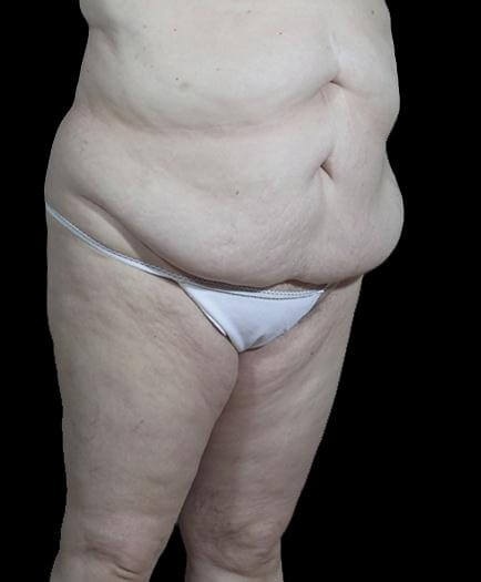 Abdominoplasty Procedure Before