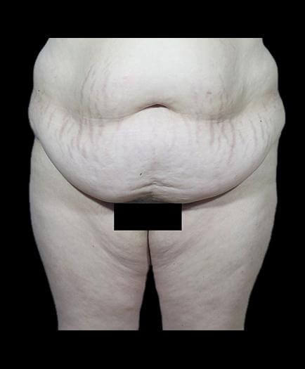 Tummy Tuck & Lipo Front View Before