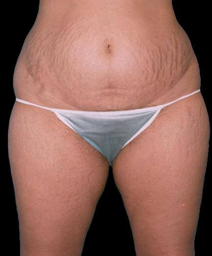 Female Tummy Tuck Before