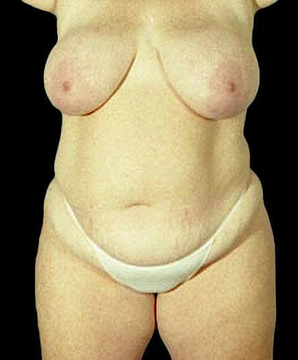 Women’s Tummy Tuck Front View Before