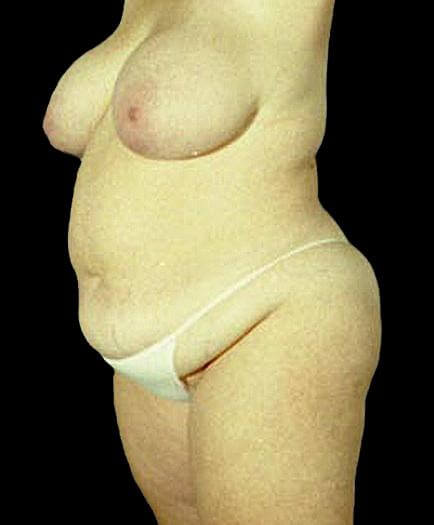 Women’s Tummy Tuck Quarter View Before