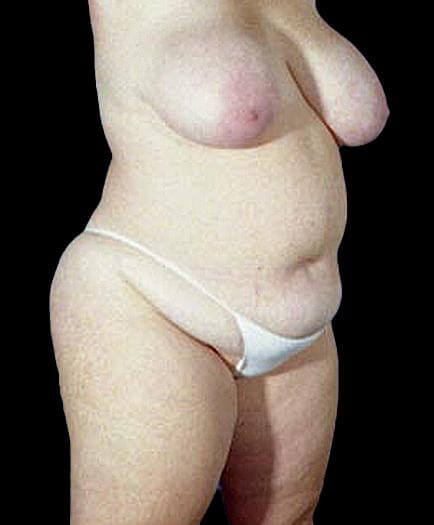 Women’s Tummy Tuck Before