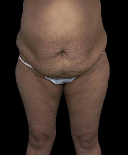 Abdominoplasty & Lipo Front View Before