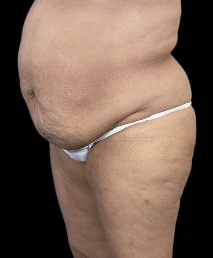 Abdominoplasty & Lipo Quarter View Before