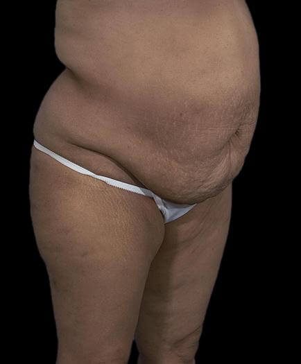 Abdominoplasty & Lipo Quarter View Before