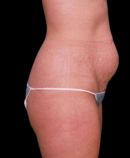 Abdominoplasty & Lipo Side View Before