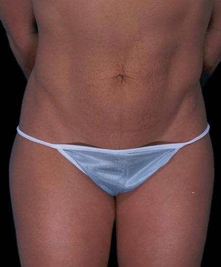 Women’s Tummy Tuck Surgery Before	