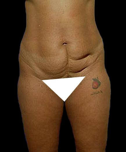 Before Tummy Tuck