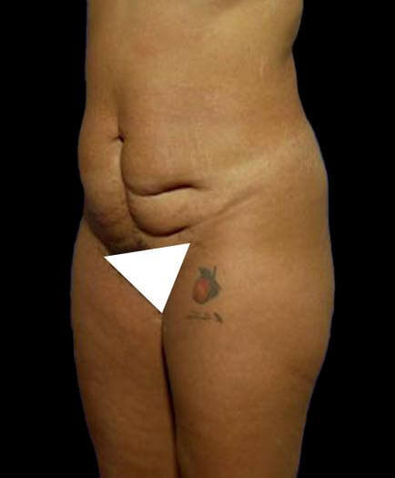 Before Tummy Tuck Surgery