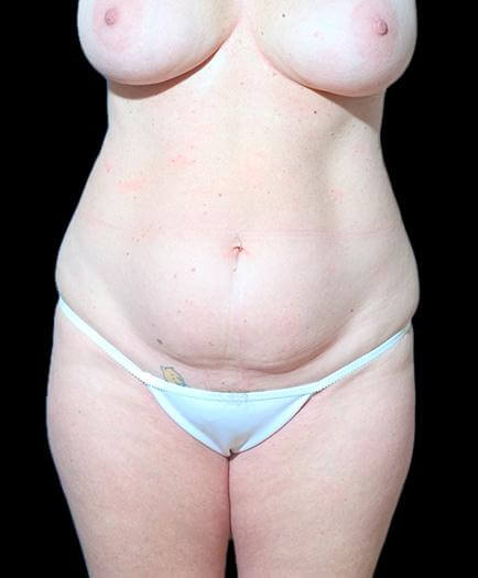 Before Abdominoplasty