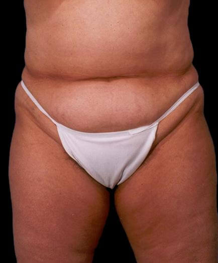 Before Abdominoplasty Surgery Front View
