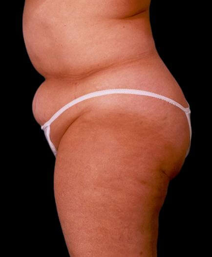 Before Abdominoplasty Surgery Side View