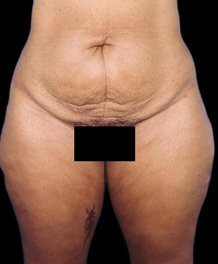 Front View Tummy Tuck Before