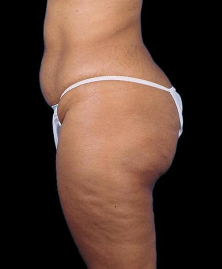 Side View Tummy Tuck Before