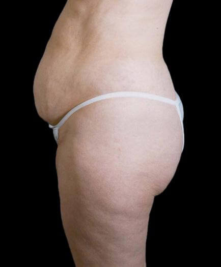 Stomach Lipo & Tummy Tuck Side View Before