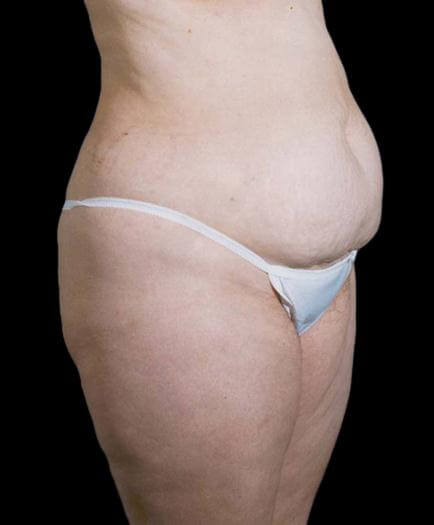 Stomach Lipo & Tummy Tuck Quarter View Before