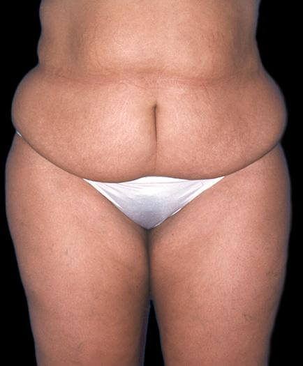 Female Tummy Tuck Surgery Before