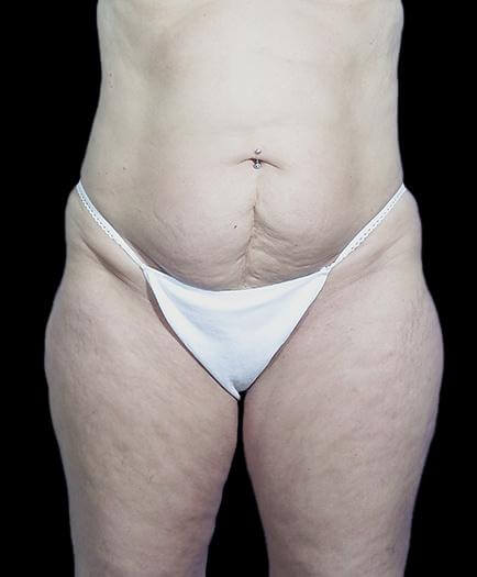 Stomach Abdominoplasty Before