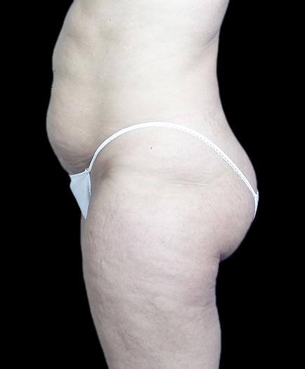 Stomach Abdominoplasty Side View Before