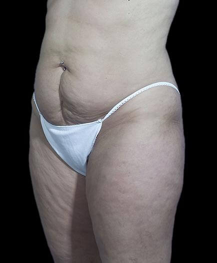 Stomach Abdominoplasty Quarter View Before