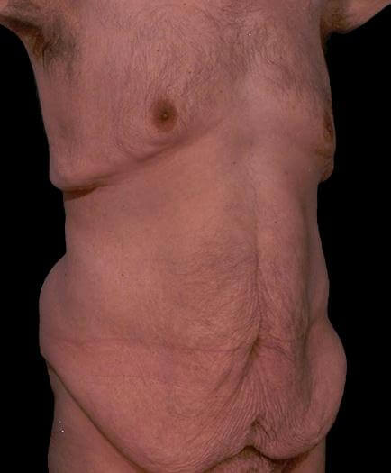 Male Tummy Tuck Quarter View Before 	