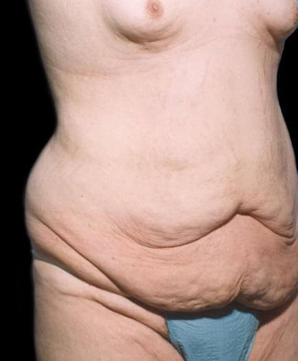 Male Abdominoplasty Quarter View Before