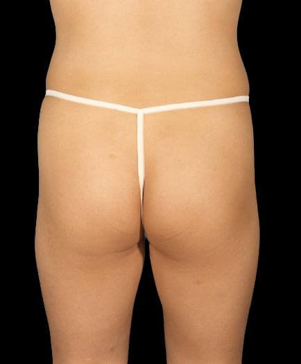 Buttock Augmentation Back View Before