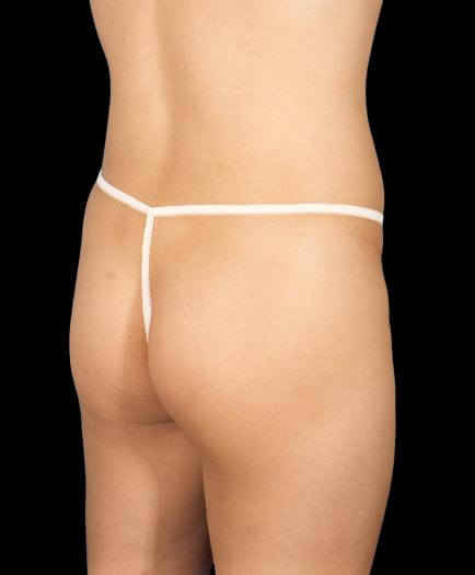 Buttock Augmentation Before