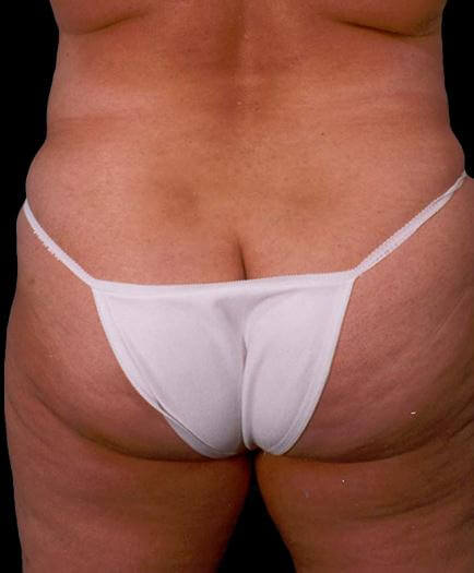 Buttock Contouring Before
