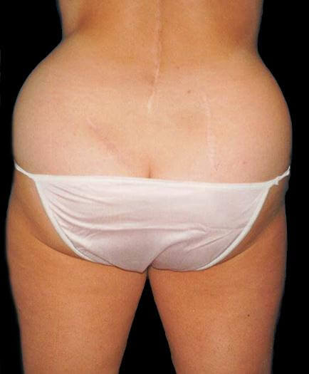 Buttock Liposuction Before