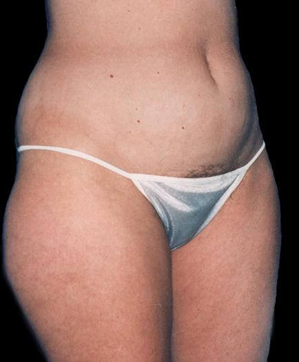 Liposuction Surgery Before