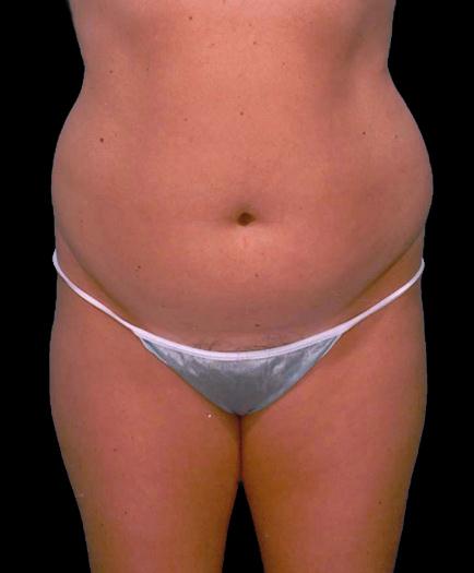 Female Liposuction Before 