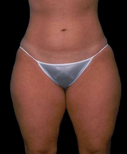 Thigh Liposuction Before