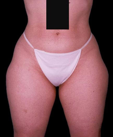 Thigh Lipo Surgery Front View Before