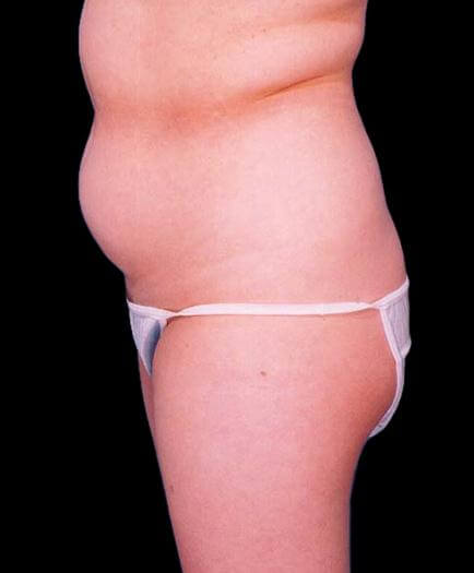 Stomach Lipo Before